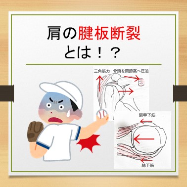 肩関節の腱板断裂とは？